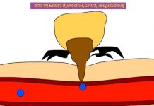 ಹಸುಗಳಲ್ಲಿ ಮಾರಕ ಉಣ್ಣೆ ರೋಗ; ಉದಾಸೀನ ಬೇಡ